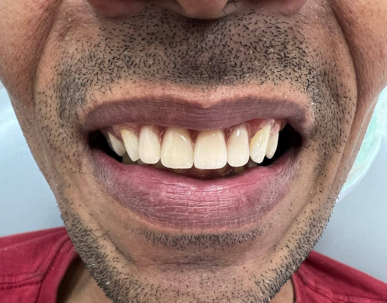 Depois do tratamento odontológico - caso 1