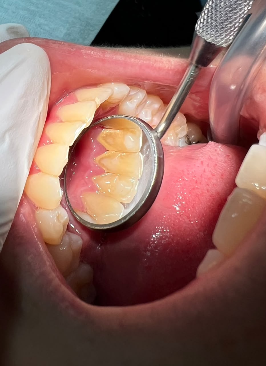 Antes do tratamento odontológico - caso 2