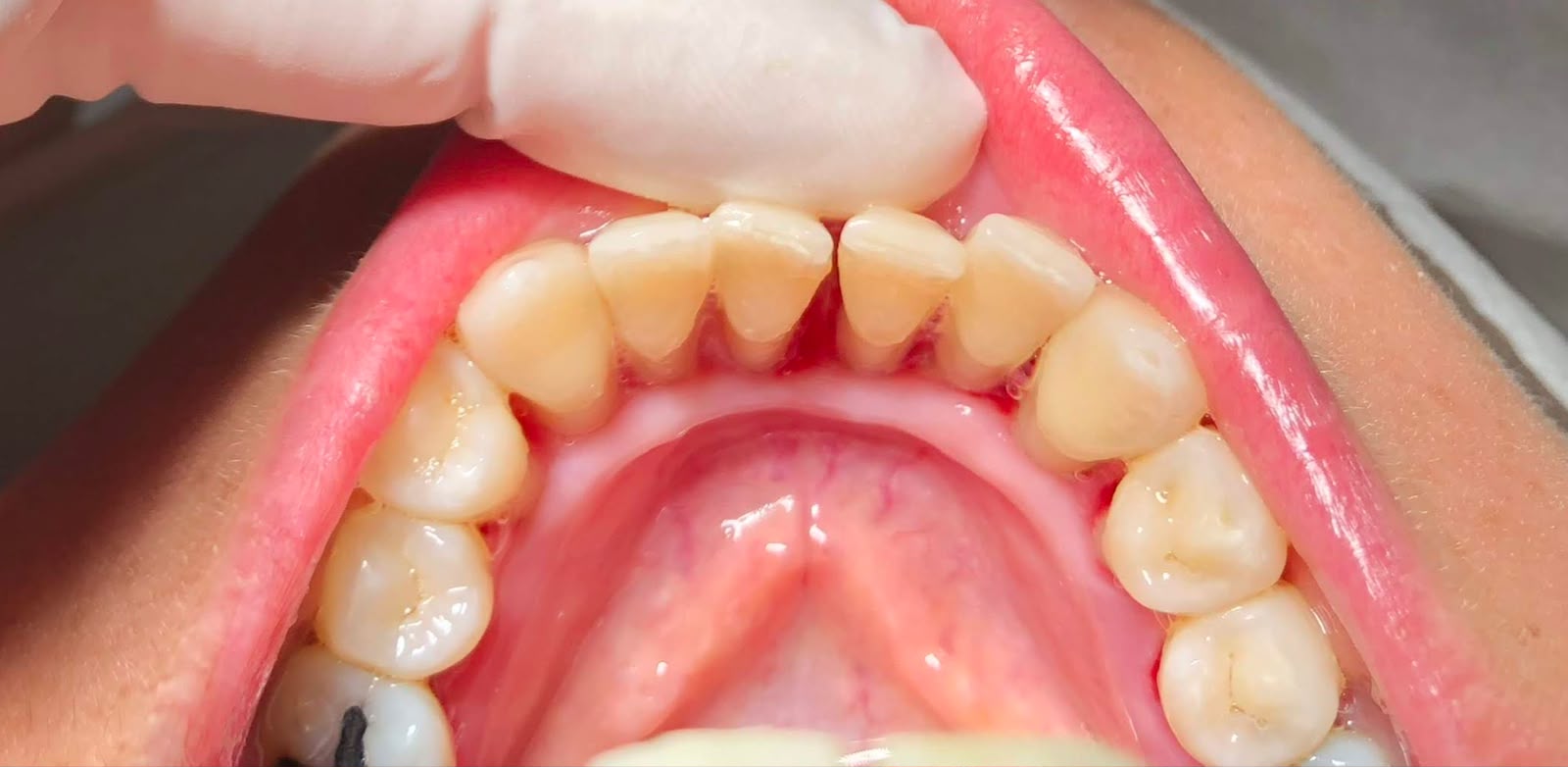 Depois do tratamento odontológico - caso 3